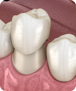 DENTAL CROWNS