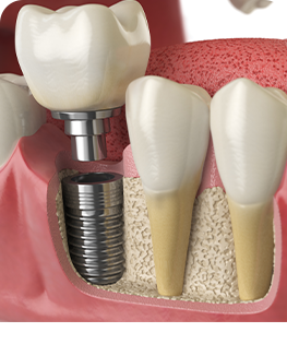 DENTAL IMPLANTS