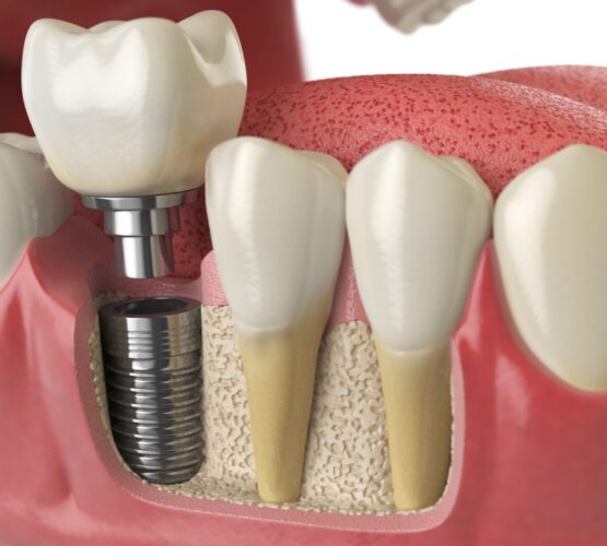 Dental Implants